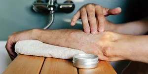 Làm thế nào để loại bỏ vảy nến một cách an toàn