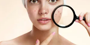 Đối phó với thâm và sẹo mụn