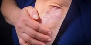 Bệnh viêm khớp vảy nến là gì? Triệu chứng, Nguyên nhân, Chẩn đoán, Điều trị và Phòng ngừa