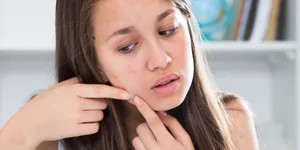 Trị mụn : Làm sao loại bỏ mụn một cách tự nhiên