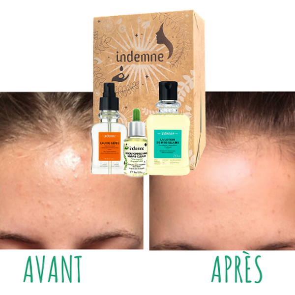 Bộ trị mụn Indemne