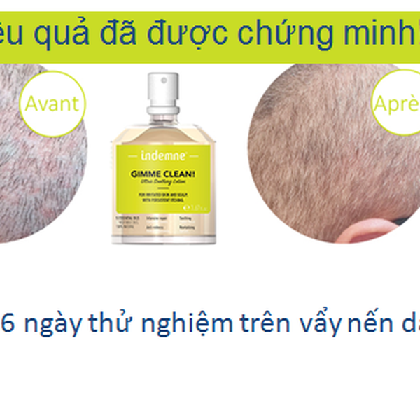 Tinh chất điều trị vẩy nến da và nấm da đầu INDEMNE - GIMME CLEAN LOTION