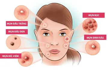 Peel acne Peel acne