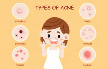 Các loại mụn thường gặp và cách phân biệt dễ dàng Các loại mụn thường gặp và cách phân biệt dễ dàng