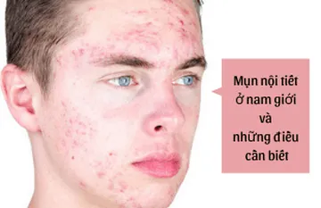 Mụn nội tiết ở nam giới và những điều cần biết Mụn nội tiết ở nam giới và những điều cần biết
