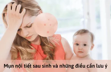 Mụn nội tiết sau sinh và những điều cần lưu ý Mụn nội tiết sau sinh và những điều cần lưu ý