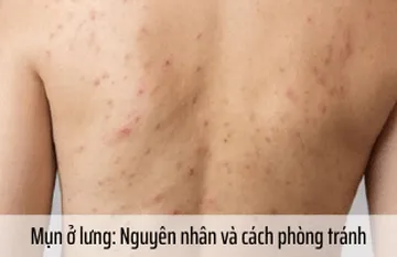 Mụn trứng cá ở lưng: Nguyên nhân và cách phòng tránh Mụn trứng cá ở lưng: Nguyên nhân và cách phòng tránh