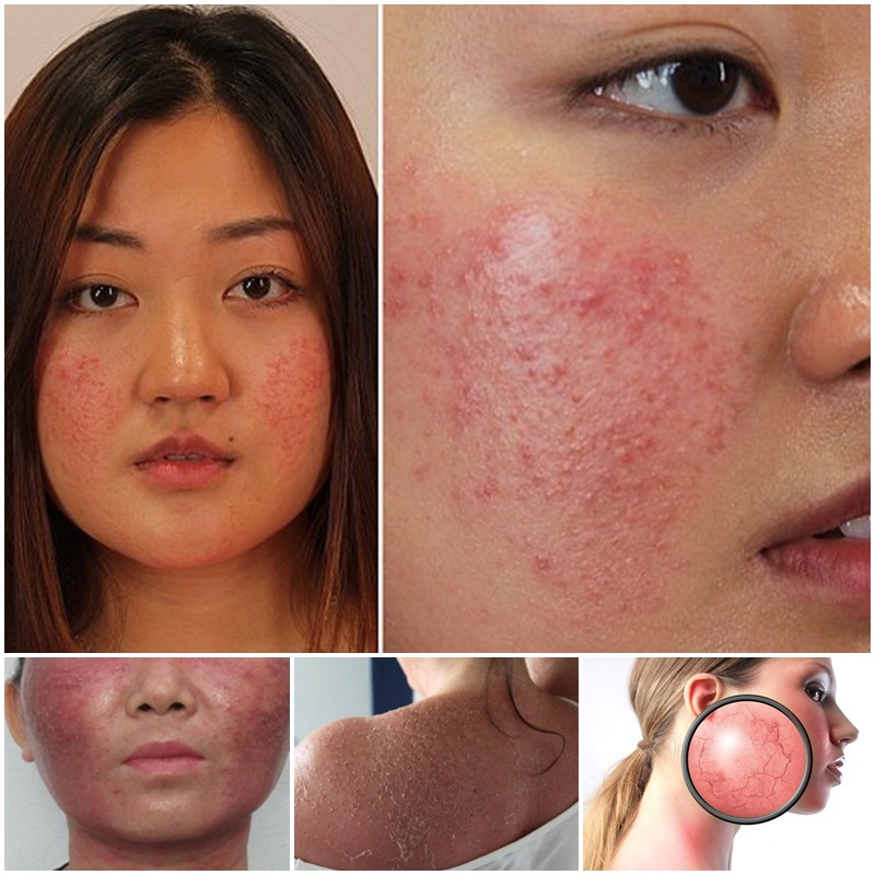 cac dau hieu nhiem doc corticoid