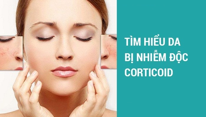 da nhiem doc corticoid