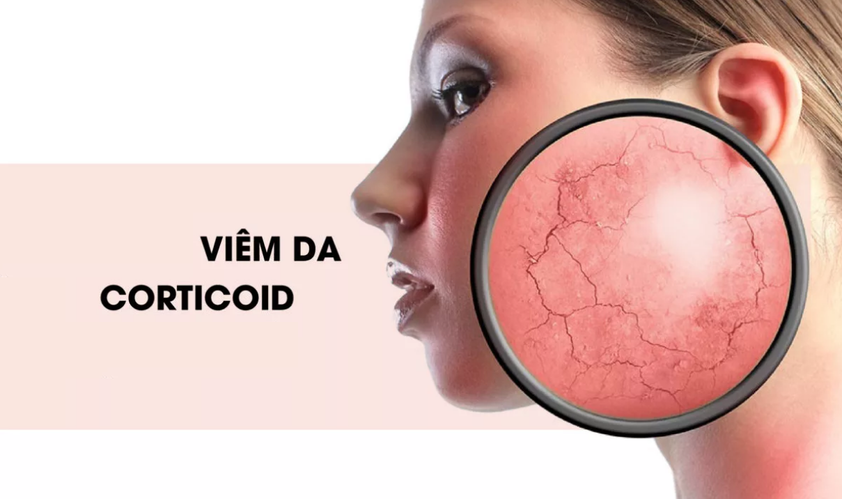 dieu tri da bi nhiem chat corticoid 4