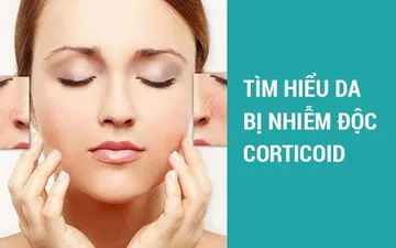 DA NHIỄM ĐỘC CORTICOID - NHẬN BIẾT - CẢNH BÁO - GIẢI PHÁP