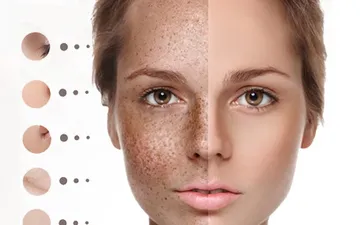 Sốc nặng khi thoa Vitamin E và B1 trộn với nhau lên da mặt Nám