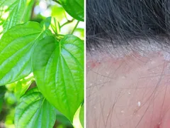 TRỊ VẢY NẾN DA ĐẦU BẰNG LÁ TRẦU KHÔNG