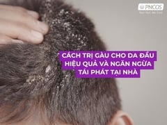Cách trị gàu cho da đầu hiệu quả và ngăn ngừa tái phát tại nhà