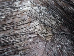 CHĂM SÓC TÓC KHI BỊ NẤM DA ĐẦU