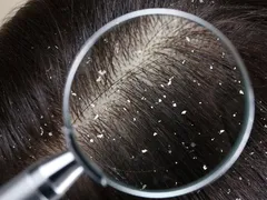 CÁC CÁCH TRỊ GÀU HIỆU QUẢ TẠI NHÀ