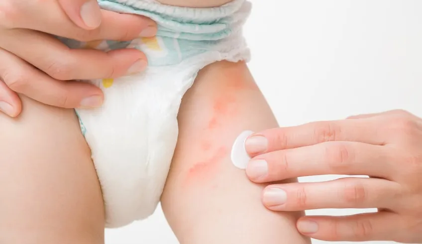 Bé gái bị ngứa vùng kín, ngứa bộ phận sinh dục phải làm sao?