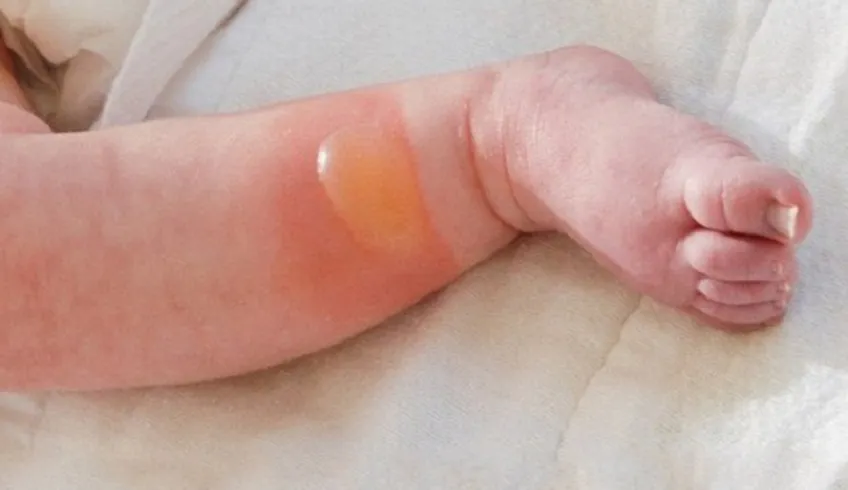 Các bước sơ cứu ban đầu trẻ bị bỏng
