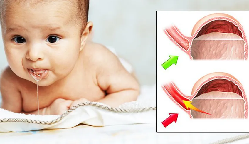 Cách điều trị trào ngược dạ dày ở trẻ em người lớn cần biết