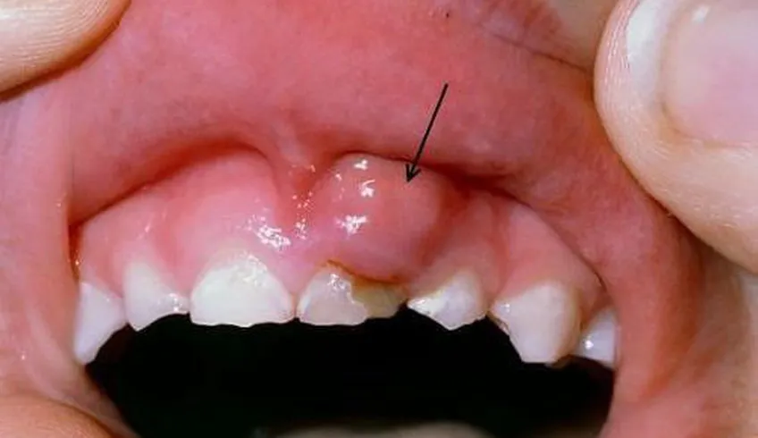 Chú ý đề phòng viêm lợi ở tuổi ăn dặm