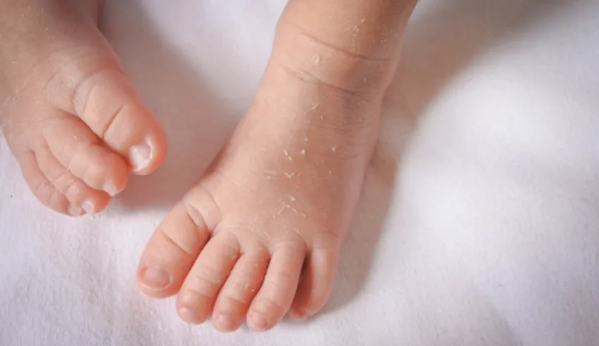 Da khô ở trẻ sơ sinh và trẻ em