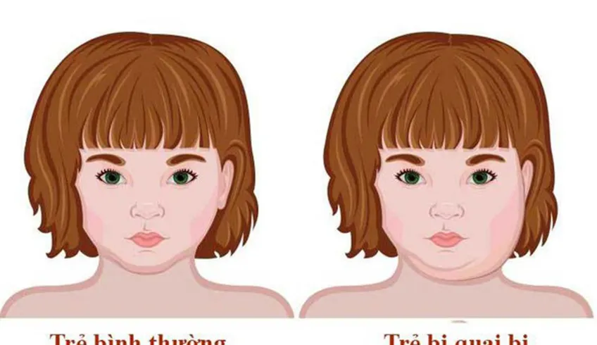 Dấu hiệu quai bị ở trẻ nhỏ cha mẹ cần biết