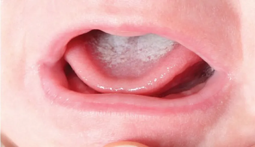 Điều trị nấm miệng ở trẻ em