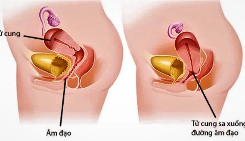 Sau sinh đi lại nhiều có bị sa tử cung không? Biết sớm đỡ hại mẹ ơi!