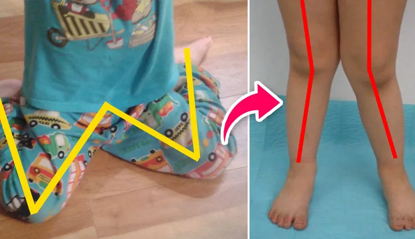 Vì sao không nên cho trẻ ngồi tư thế chữ W?