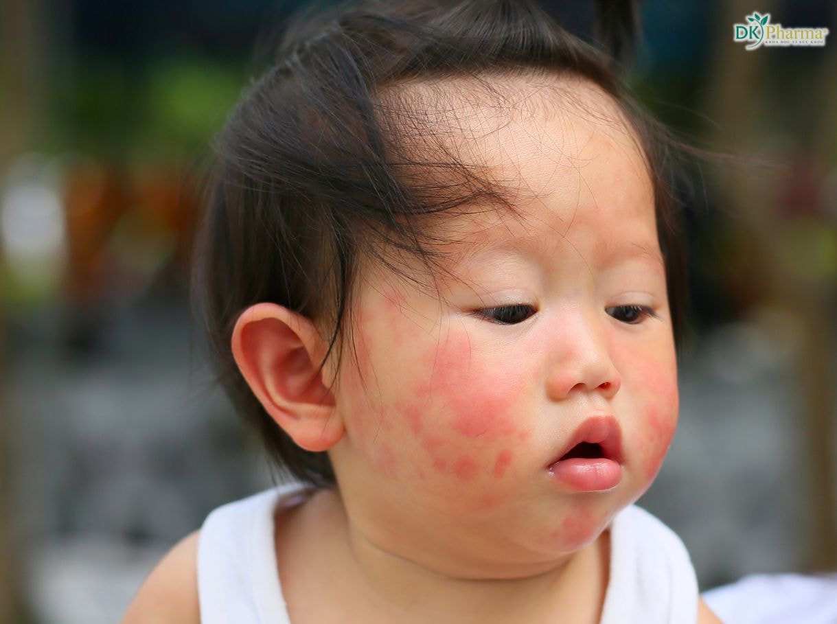 Rôm sảy ở trẻ sơ sinh và trẻ nhỏ - Sữa tắm elemis