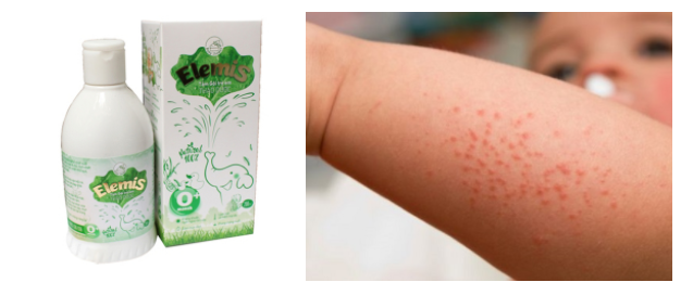 Trị rôm sẩy chính là tác dụng bất ngờ của nước tắm thảo dược ELEMIS Trị rôm sẩy chính là tác dụng bất ngờ của nước tắm thảo dược ELEMIS