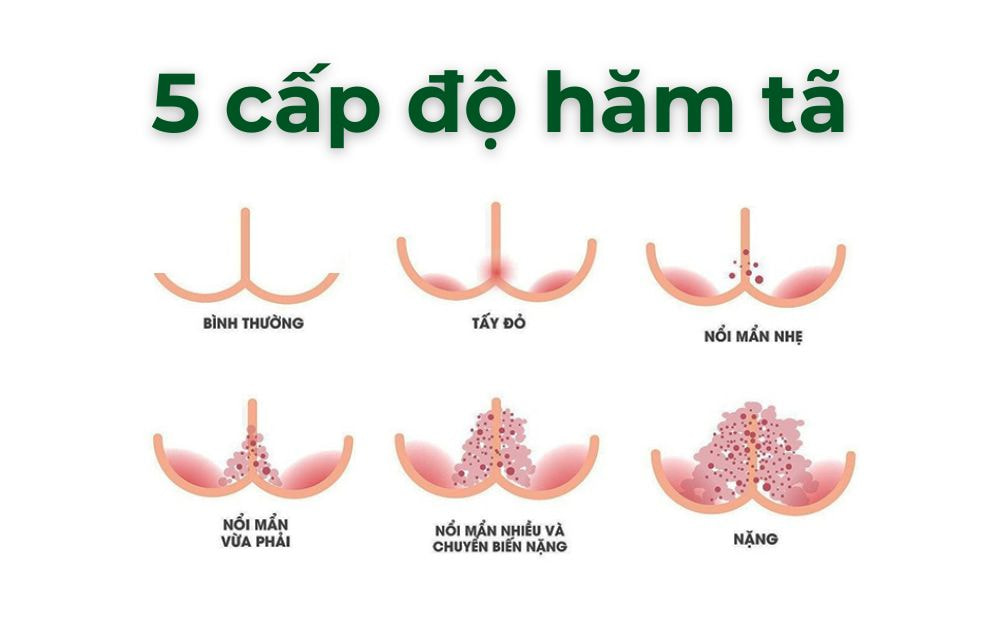 5 cấp độ hăm tã ở trẻ sơ sinh - Sữa tắm Elemis