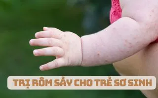 Mách mẹ 6 cách trị rôm sảy cho trẻ sơ sinh hiệu quả tại nhà