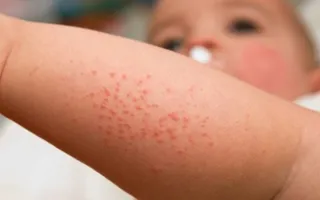 Trẻ bị rôm sẩy có dùng sữa tắm Elemis được không?