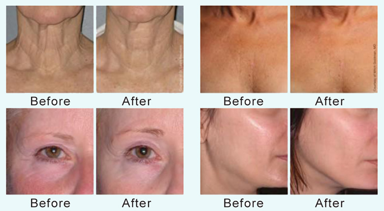 Hình ảnh Máy nâng cơ HIFU FU4.5-2S trước và sau điều trị Hình ảnh Máy nâng cơ HIFU FU4.5-2S trước và sau điều trị