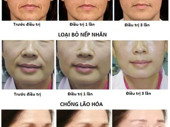 So sánh công nghệ hifu và ultherapy: Giống và khác nhau ở điểm nào?