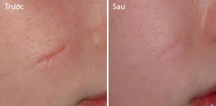 Kết quả cải thiện sẹo lõm sau một thời gian sử dụng Kem xoá mờ sẹo, thâm, rỗ, lõm Scar Esthertique Kết quả cải thiện sẹo lõm sau một thời gian sử dụng Kem xoá mờ sẹo, thâm, rỗ, lõm Scar Esthertique