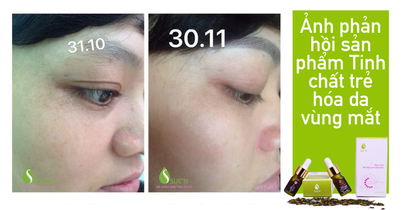 Kết quả sau 1 tháng sử dụng Serum dưỡng mắt Suen Kết quả sau 1 tháng sử dụng Serum dưỡng mắt Suen
