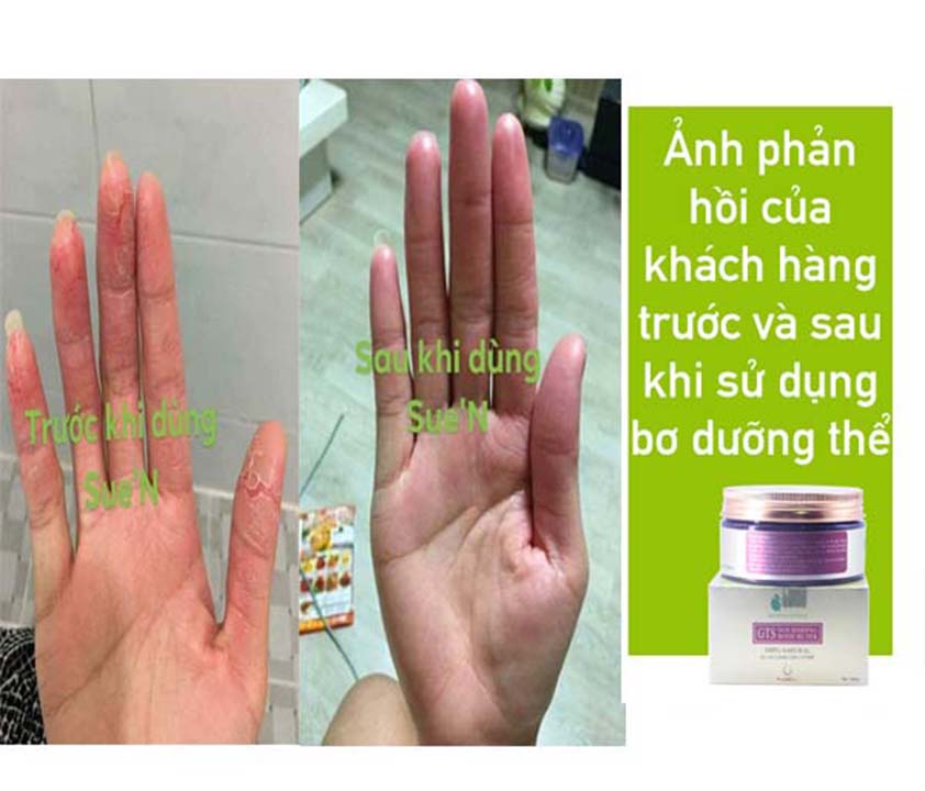 Kết quả sử dụng bơ dưỡng thể Suen Kết quả sử dụng bơ dưỡng thể Suen