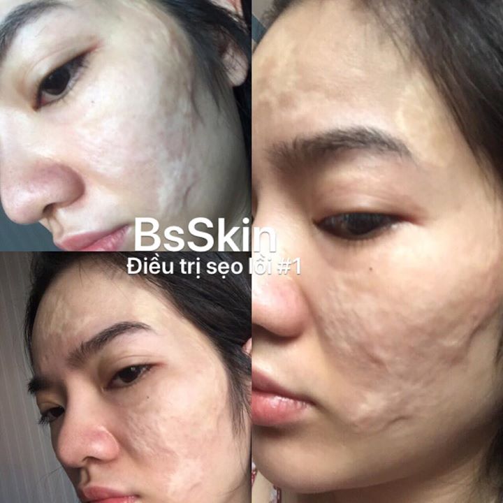 Tinh chất trị sẹo rỗ BeCare 23131 giúp trị sẹo lồi và da không đều màu Tinh chất trị sẹo rỗ BeCare 23131 giúp trị sẹo lồi và da không đều màu