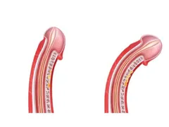 Hình dáng dương vật thường thấy nhất ở nam giới