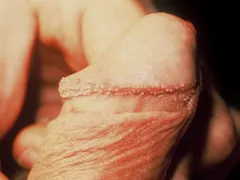 Phân Biệt Chuỗi Hạt Ngọc và Bệnh Sùi Mào Gà - Mr1985