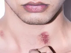 Hickey là gì? Hickey có nguy hiểm không? Mr1985