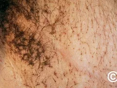 Rận mu là gì? Đừng chủ quan nếu vùng kín ngứa bất thường! Mr1985