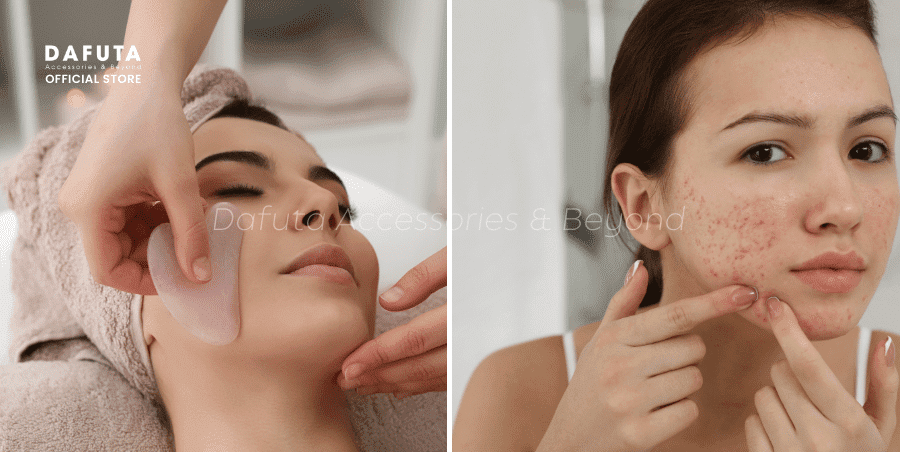 Đá tự nhiên làm đẹp da mụn