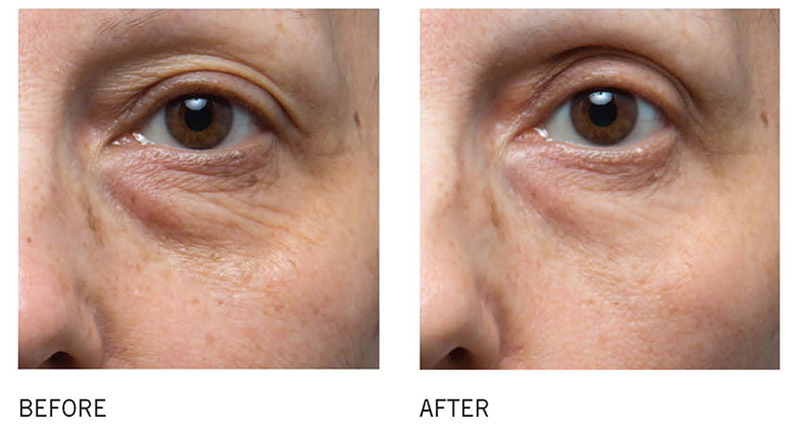 Vitamin C rất tốt trong việc phục hồi làn da mắt.