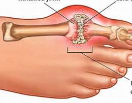 Bệnh Gut Bệnh Gut
