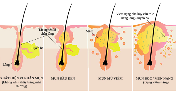 Lỗ chân lông bị tắc nghẽn là nguyên nhân gây ra mụn