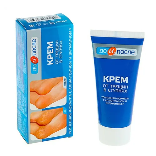 Kem trị nứt gót chân KPEM