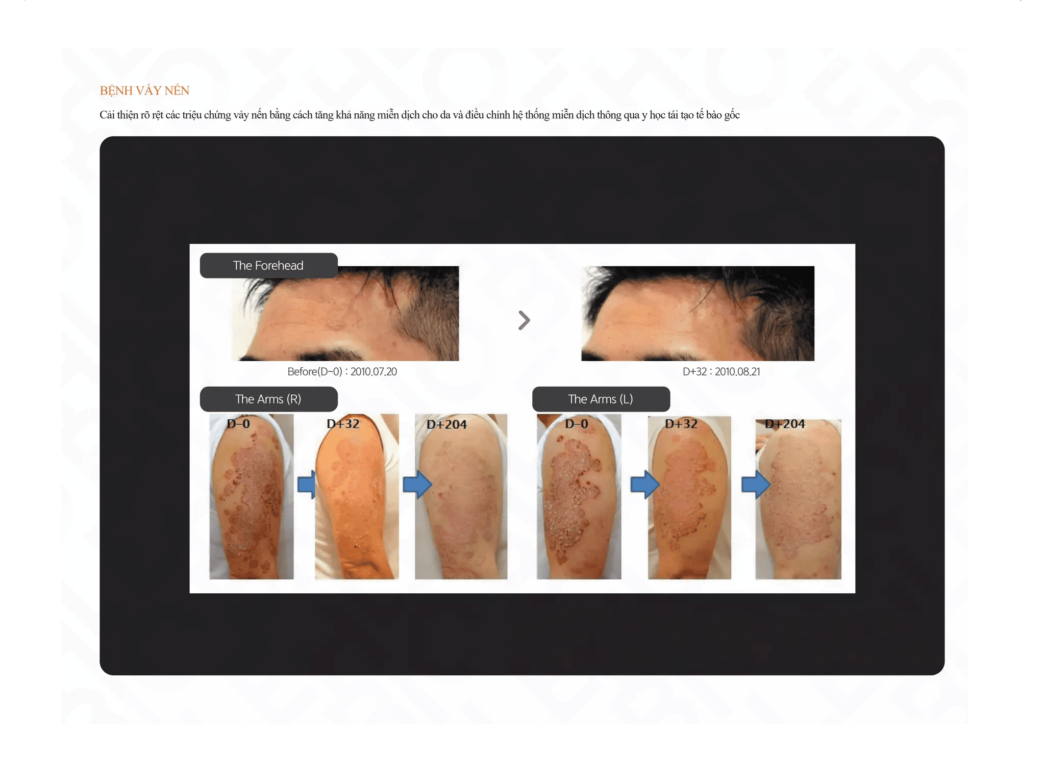 Điều trị bệnh vẩy nến bằng Tế bào gốc